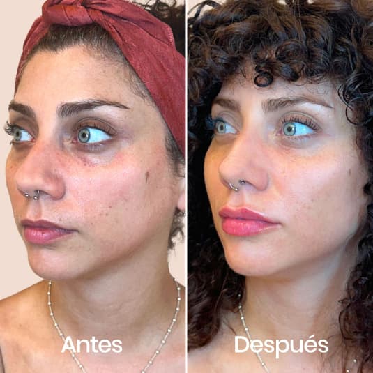 Proyección de pómulos antes y después - Resultado 1 - Holaglow