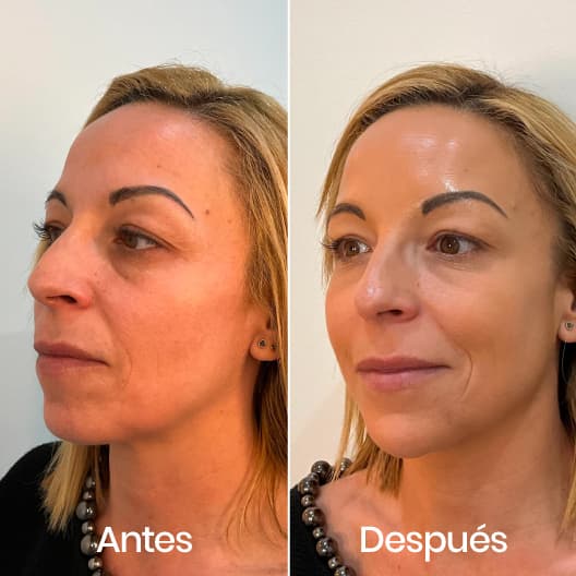 Relleno de ojeras antes y después - Resultado 2 - Holaglow
