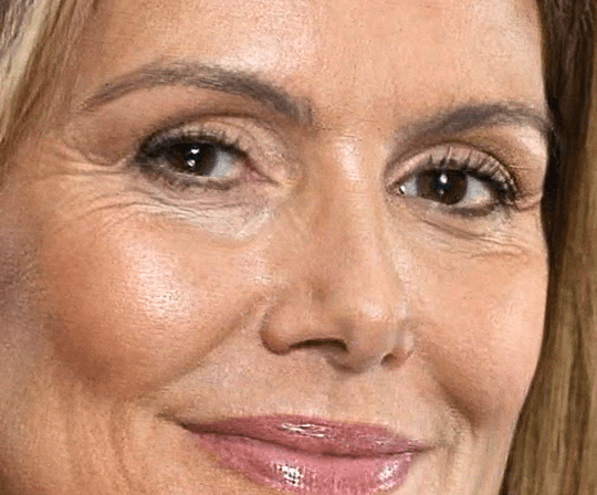 Armonización facial Basic